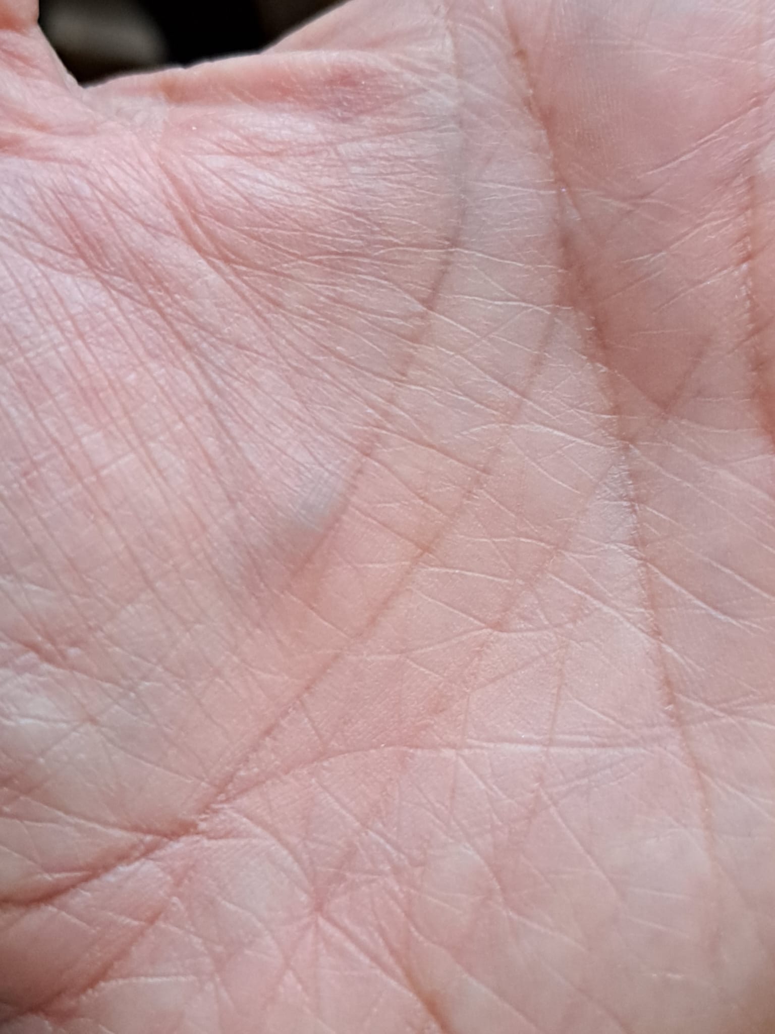 Verdikte ader handpalm Huisarts.nl